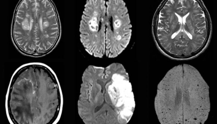 Can COVID can damage the brain? See how it can
